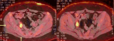 PET-CT with colorectal recurrence