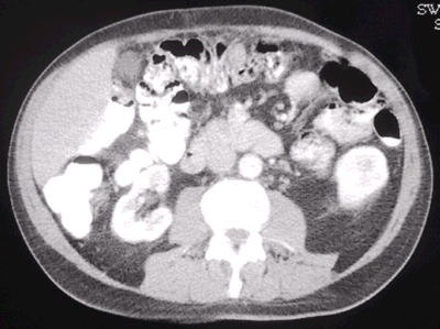 CT with mesenchymal tumor recurrence